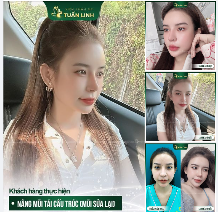 Mũi to thô, mũi lộ sóng bóng đỏ Chọn nâng mũi tái cấu trúc sửa lại tại Tuấn Linh nha!