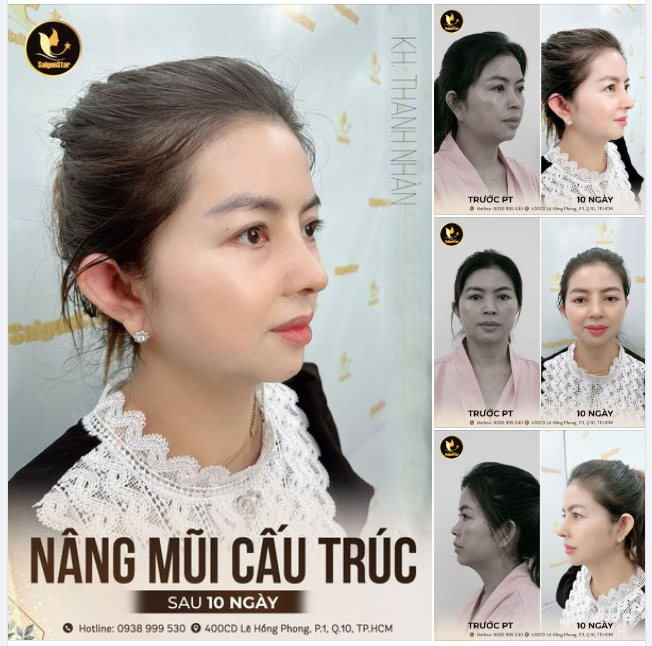 Dáng mũi cấu trúc 10 có làm chị em xao xuyến?