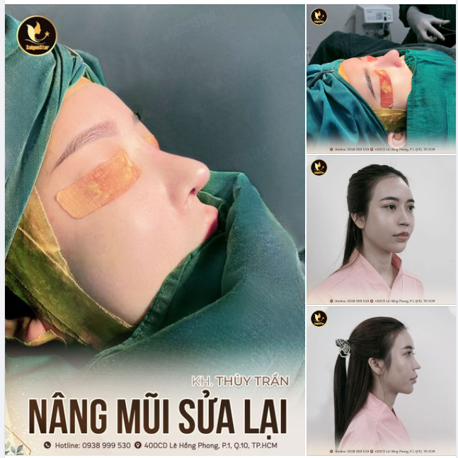 NÂNG MŨI CẤU TRÚC SỬA LẠI – KHÔNG ĐAU ÍT SƯNG BẦM