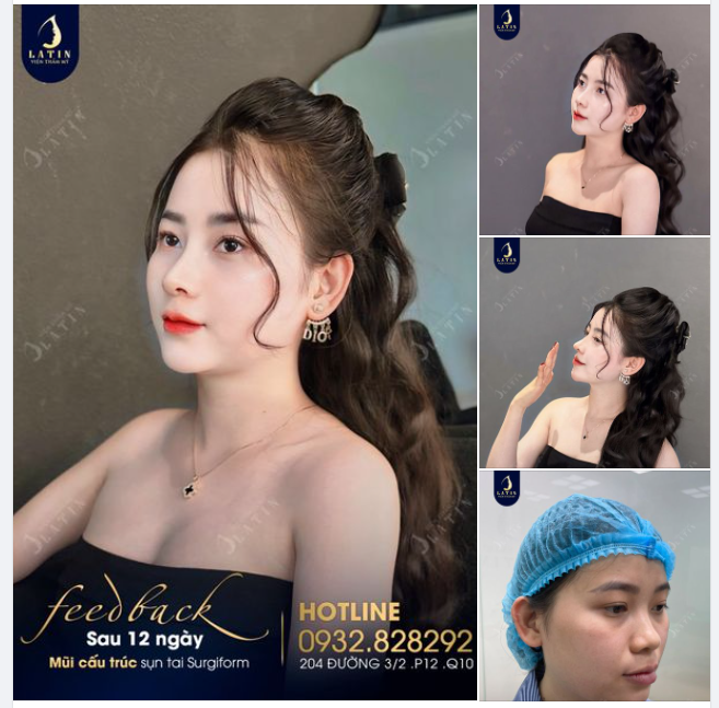 Tin được không, mũi mới nâng 12 ngày đây ạ! Feedback quá là chất lượng đến từ em gái xinh đẹp.