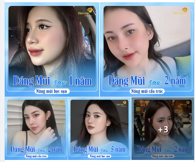 Tổng Hợp Những Case Nâng Mũi Đẹp Tại Thiện Mỹ