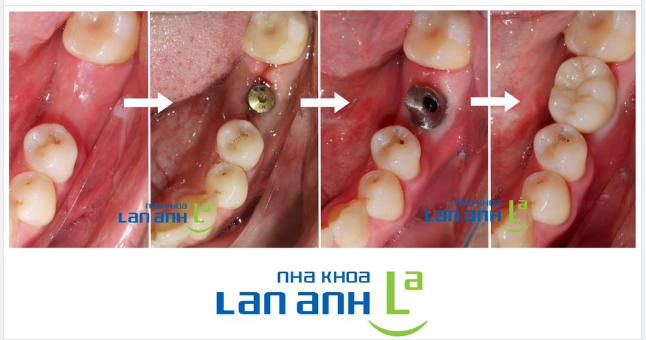 Những lưu ý sau khi phục hình răng sứ trên Implant