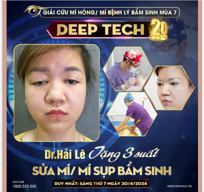 Sửa mí 0 ĐỒNG tại Dr.Hải Lê - Sài Gòn. Bạn đã sẵn sàng?