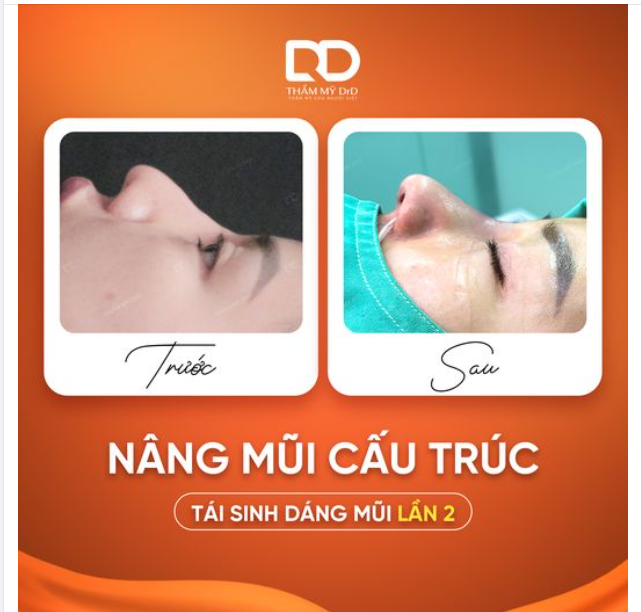 TÁI TẠO DÁNG MŨI CẤU TRÚC MỚI CỰC XINH