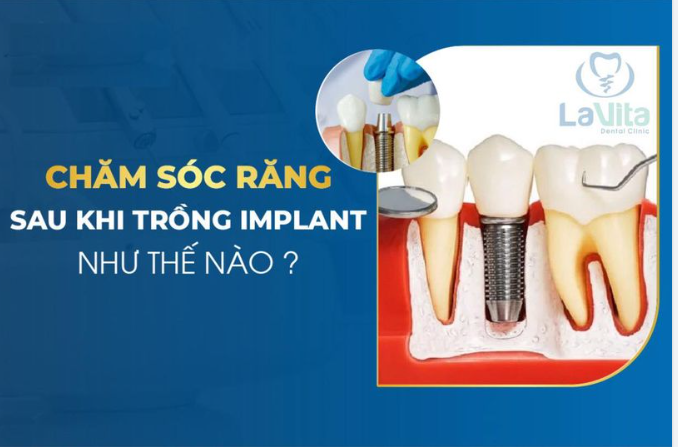 NHỮNG LƯU Ý CHĂM SÓC RĂNG – MIỆNG SAU KHI CẤY GHÉP IMPLANT