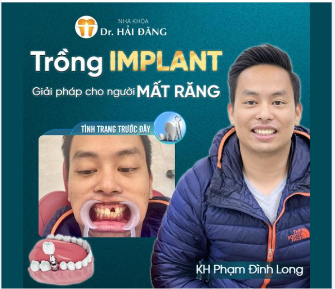 TRỒNG IMPLANT GIẢI PHÁP CHO NGƯỜI MẤT RĂNG