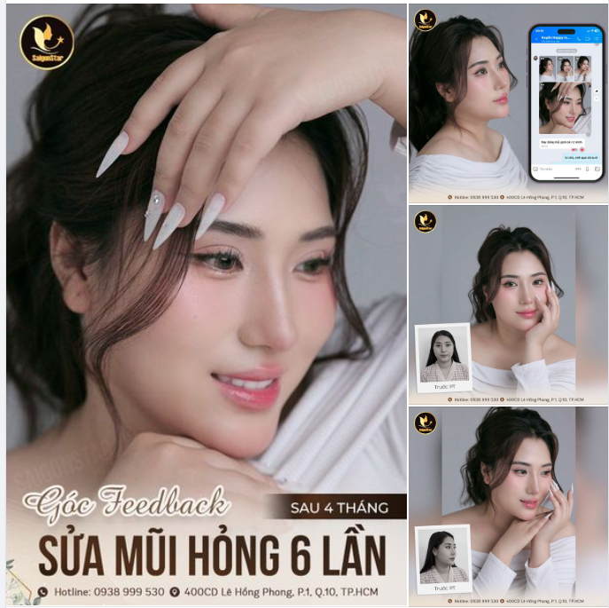 GÓC FEEDBACK: SAU 4 THÁNG SỬA LẠI MŨI HỎNG 6 LẦN