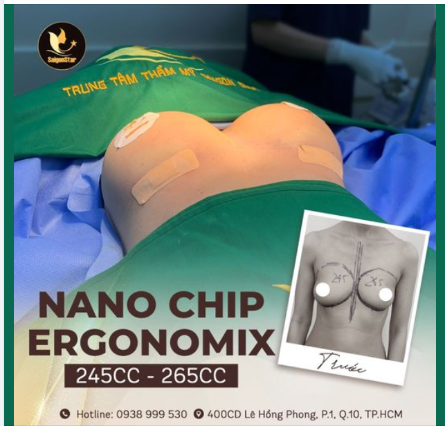 NÂNG NGỰC NANO CHIP ERGONOMIX SIZE 245CC (L) - 265CC (R) THÀNH CÔNG ĐỔI SIZE VÒNG 1 CHO MẸ BỈM 2 CON