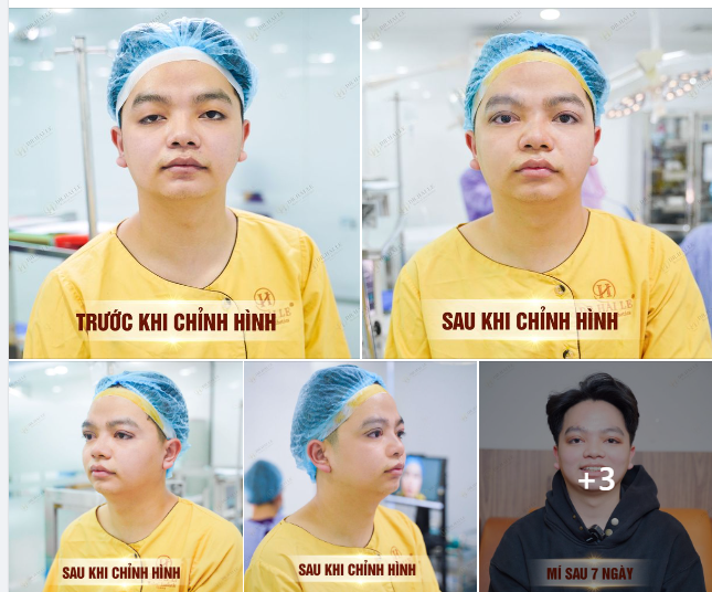 Mí bệnh lý bẩm sinh bao gồm các tình trạng như nhược cơ nâng mi (sụp mí) một hoặc cả 2 mắt, cường cơ nâng mi (trợn mí) một hoặc cả 2 mắt, vừa cường cơ vừa nhược cơ…