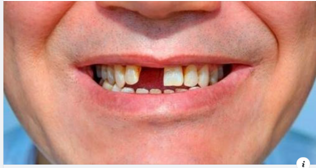 Không trồng răng giả sau khi nhổ răng có sao không?