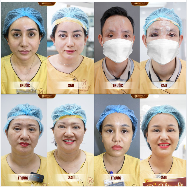 HỆ LỤY TỪ BIẾN CHỨNG MÍ HỎNG - KINH NGHIỆM PTTM MẮT AN TOÀN - ĐÂU LÀ THỜI ĐIỂM VÀNG SỬA MÍ LỖI HỎNG HIỆU QUẢ