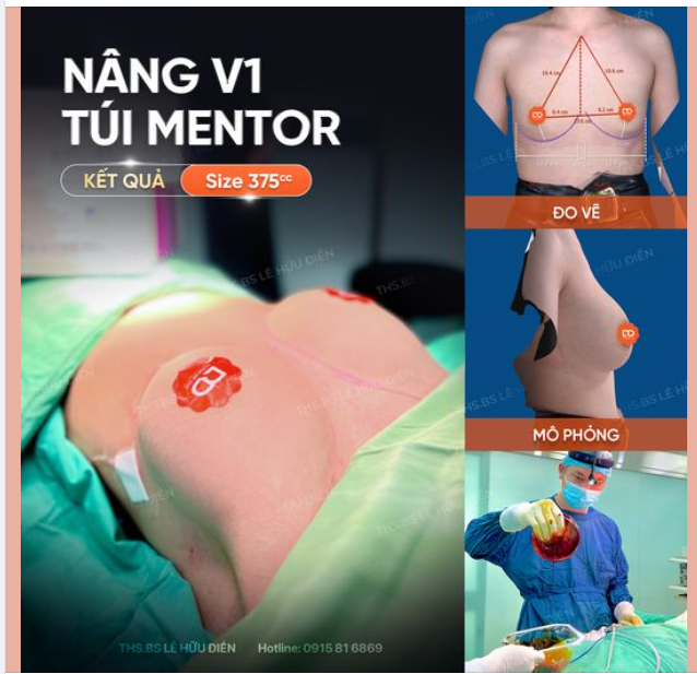 TỪ MÔ PHỎNG ĐẾN THỰC TẾ Kết quả Nâng V1 túi Mentor size 375cc.