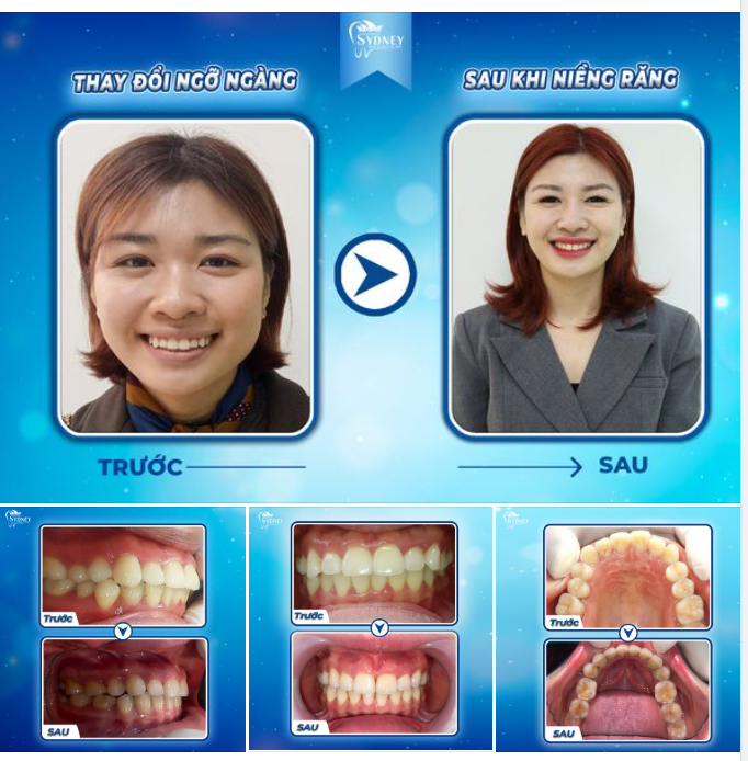 THAY ĐỔI NGỠ NGÀNG SAU KHI THÁO NIỀNG