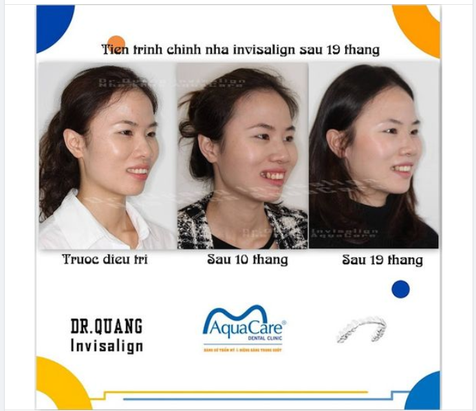 SỰ KỲ DIỆU CỦA NIỀNG RĂNG! KHẮC PHỤC HOÀN TOÀN TÌNH TRẠNG RĂNG HÔ, RĂNG KHẤP KHỂNH!