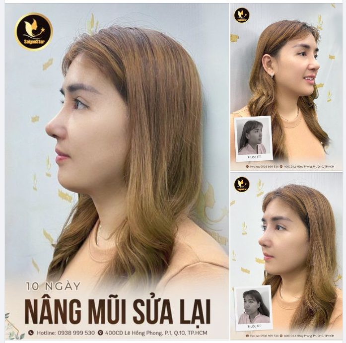 10 NGÀY NÂNG MŨI SỬA LẠI