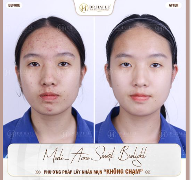 Medi-Acne Smart Bio-Light - Phương pháp trị mụn công nghệ sinh học - Lấy nhân mụn không chạm là giải pháp toàn diện được đông đảo chị em lựa chọn!