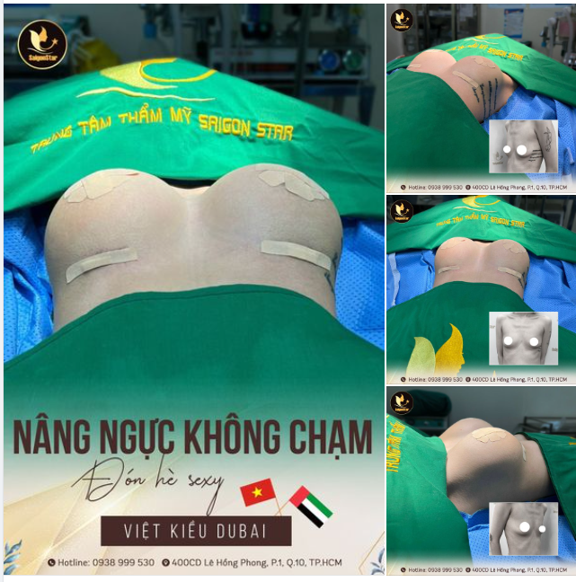 NÂNG NGỰC KHÔNG CHẠM – THOÁT LÉP TỨC THÌ
