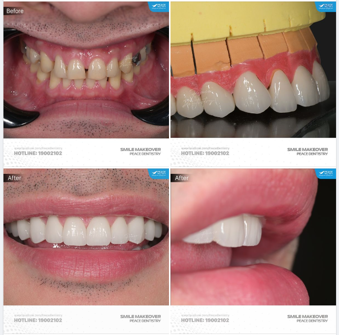 CA LÂM SÀNG THIẾT KẾ NỤ CƯỜI VỚI SỨ ZIRCAD PRIME