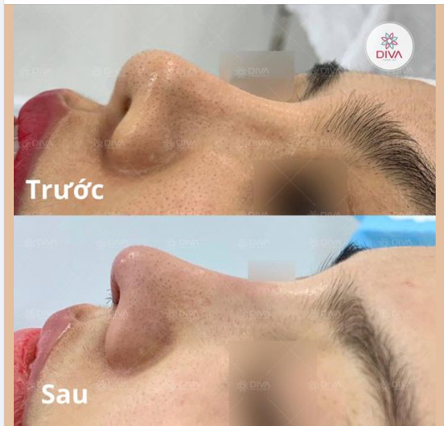 MŨI LỆCH SÓNG, MŨI HẾCH KHẮC PHỤC NHƯ THẾ NÀO?