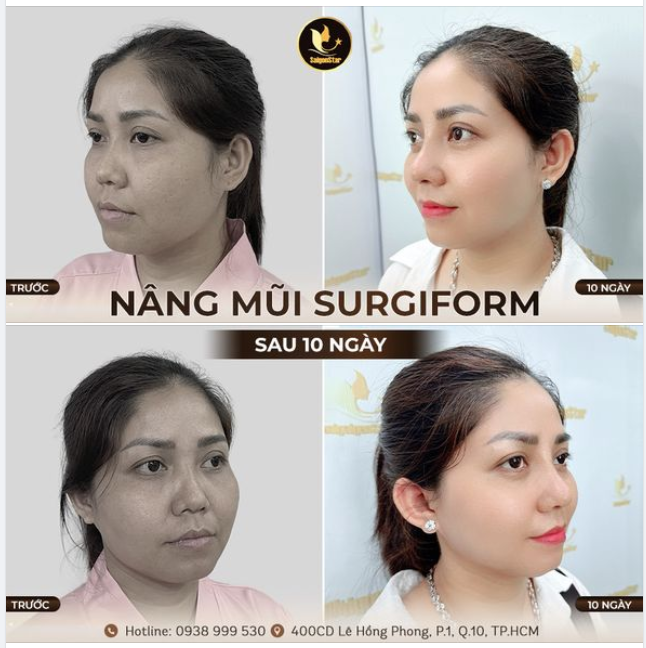 60 PHÚT THỰC HIỆN – 10 NGÀY CẮT CHỈ MŨI XẤU - NHIỀU KHUYẾT ĐIỂM  KHÔNG CÒN LÀ CHUYỆN ĐÁNG LO