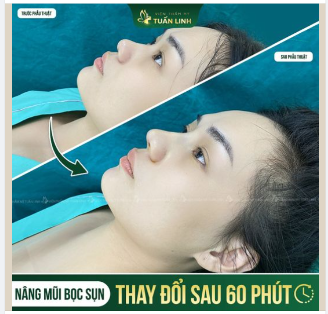 Mũi bọc sụn ƯNG QUÁ CHỪNG sau 60 phút thực hiện!!