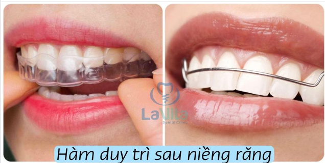 TẠI SAO PHẢI ĐEO HÀM DUY TRÌ SAU KHI KẾT THÚC QUÁ TRÌNH CHỈNH NHA?