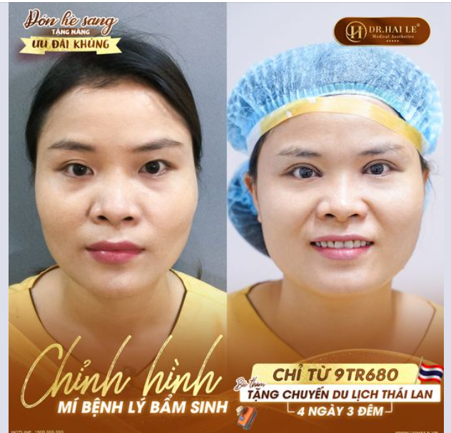 Chào tháng 5 rực rỡ hè sang, Dr.Hải Lê tặng chị em ưu đãi chỉnh hình mí bệnh lý có 1-0-2 nè