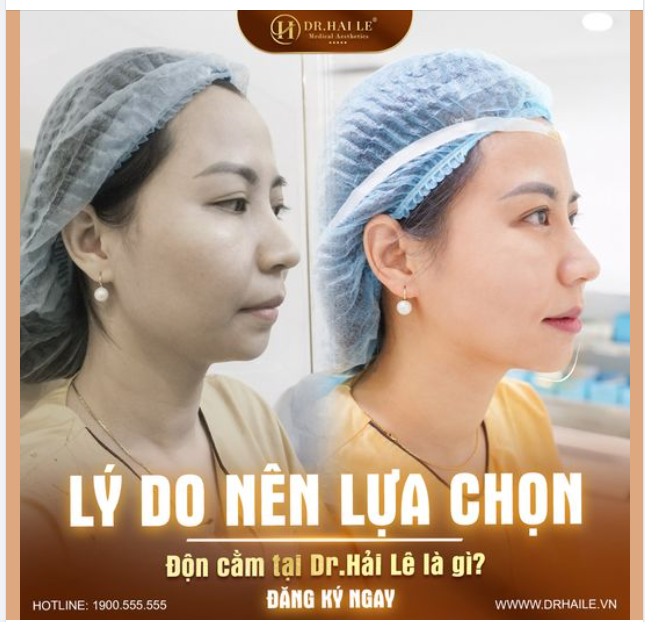 Lý do bạn nên chọn độn cằm tại Dr Hải Lê là đây
