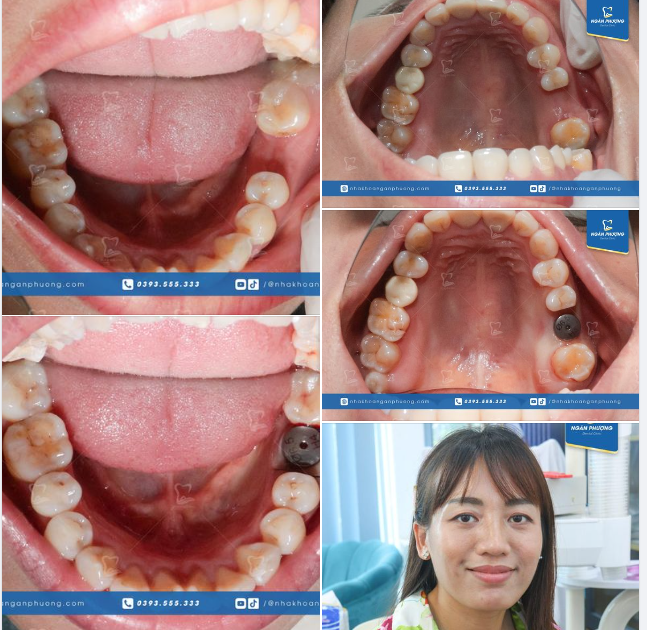 Răng 6 dễ hỏng đến vậy sao?