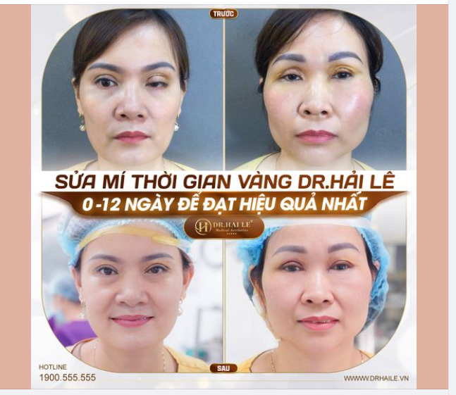 Chị khách gọi điện cho Dr.Hải Lê chia sẻ về cặp mí lỗi hỏng của mình và mong muốn Dr.Hải Lê “giải cứu”.
