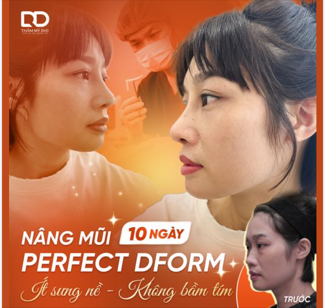Nâng mũi Perfect Dform sau khi lên dáng sẽ thế nào?