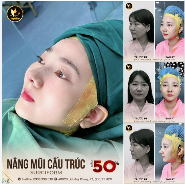 NÂNG MŨI NHƯ KHÔNG NÂNG CHO CHỊ KHÁCH HÀNG THÍCH STYLE TỰ NHIÊN