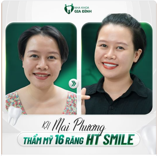 NÂNG CẤP NỤ CƯỜI - THÊM PHẦN ẤN TƯỢNG