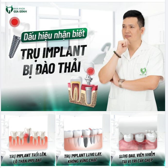 NHỮNG DẤU HIỆU NHẬN BIẾT TRỤ IMPLANT BỊ ĐÀO THẢI