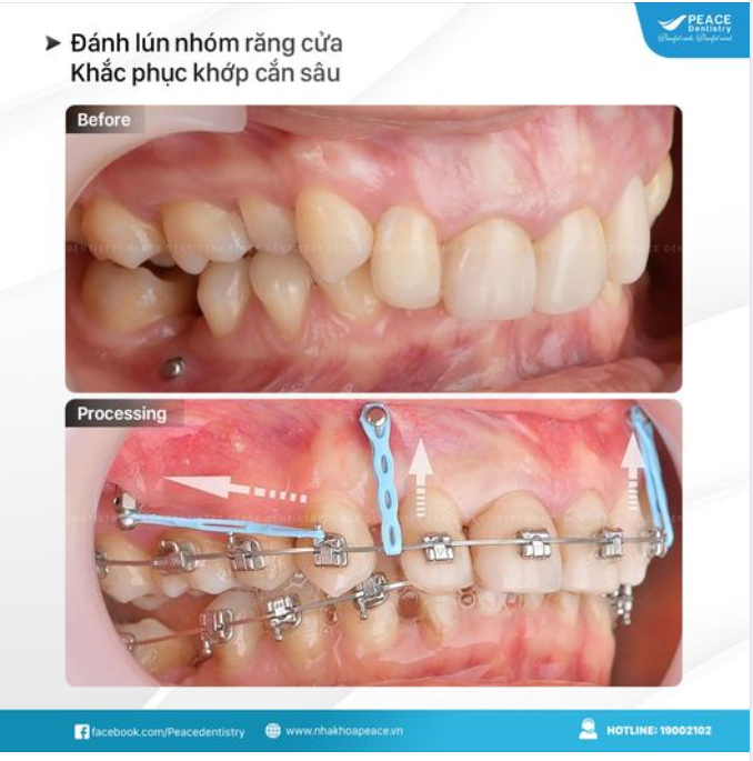KHỚP CẮN SÂU VÀ MỘT SỐ THÔNG TIN HỮU ÍCH BẠN NÊN BIẾT