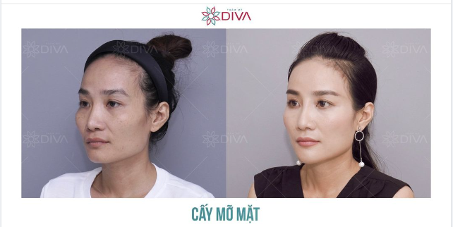 Cấy mỡ coleman, lấp đầy khuyết lõm, cân chỉnh gương mặt hài hòa đẹp tự nhiên luôn nằm trong TOP những dịch vụ làm đẹp được khách hàng yêu thích lựa chọn tại DIVA.