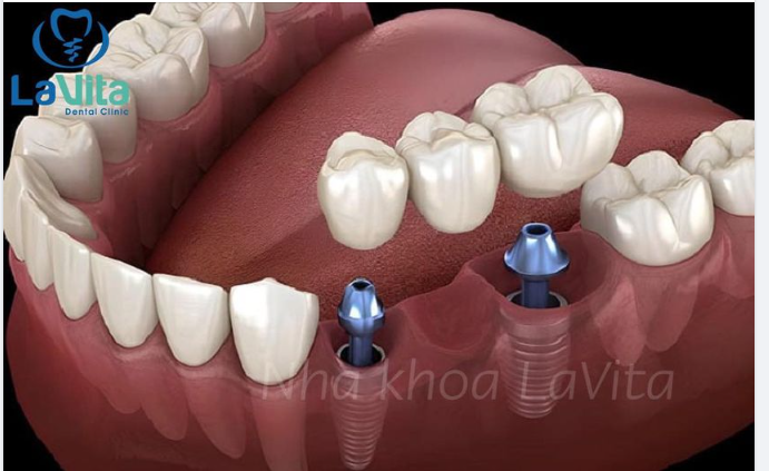 Cầu răng sứ là phương pháp phục hình răng đã mất, được chỉ định trong trường hợp cần thay thế một hoặc 2 răng bị mất.