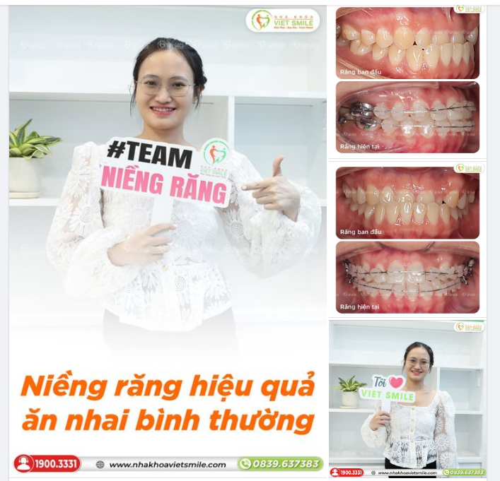 NIỀNG RĂNG HIỆU QUẢ, ĂN NHAI BÌNH THƯỜNG