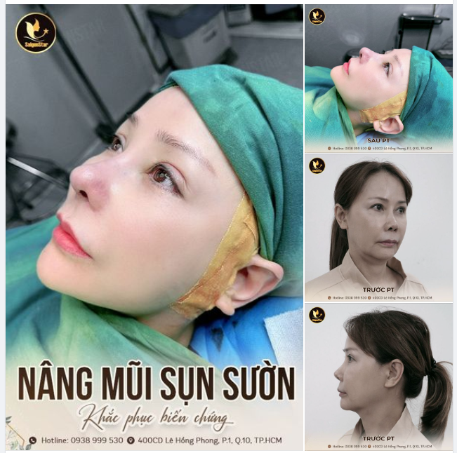 Chỉ vì chưa tìm hiểu kỹ phương pháp cũng như cơ sở nâng mũi mà mình lựa chọn, chị khách hàng đã phải gánh chịu hậu quả nặng nề của lần nâng mũi trước: