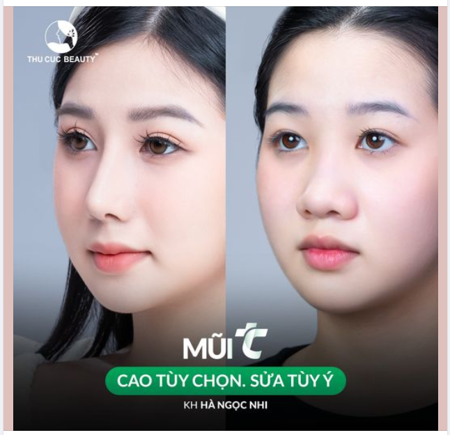 Ngọc Nhi đẹp tự nhiên sau nâng mũi