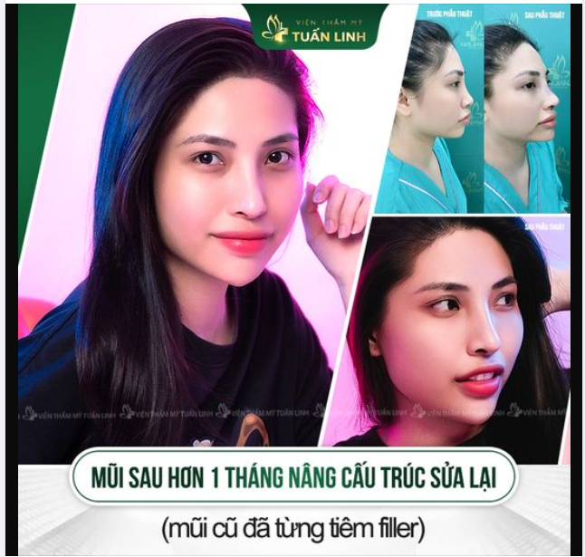 Tiêm filler bị tràn, dáng mũi không cải thiện được nhiều, liên tục phải dặm lại filler đã khiến cô nàng K.H quá mệt mỏi.