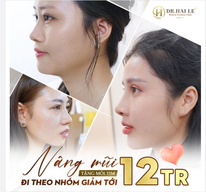 Nâng mũi đẹp xinh- Rinh ưu đãi chào Đại Lễ