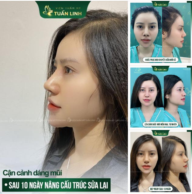 DÁNG MŨI SAU 10 NGÀY CỦA KHÁCH HÀNG TUẤN LINH