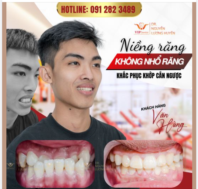 ĐÃ TỪNG CÓ MỘT HÀM RĂNG KHỚP CẮN NGƯỢC