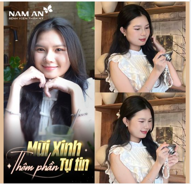 MŨI XINH THÊM PHẦN TỰ TIN