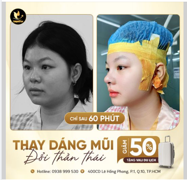 Chỉ 60 phút NÂNG MŨI CẤU TRÚC SỤN SURGIFORM, cô bạn genZ Minh Thư đã "lột xác" hoàn toàn với chiếc mũi cao thon gọn, diện mạo sáng bừng: