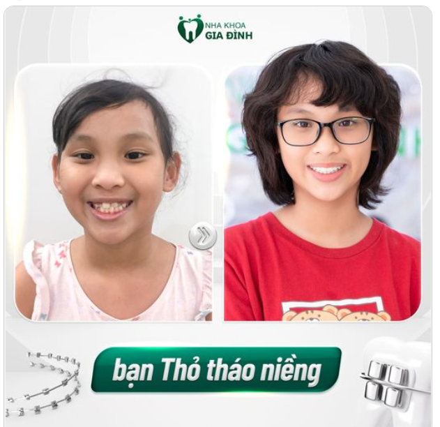 NIỀNG RĂNG ĐỂ DẬY THÌ THÀNH CÔNG