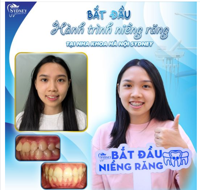 BẮT ĐẦU HÀNH TRÌNH NIỀNG RĂNG CÙNG CÔ NÀNG TÚ QUYÊN
