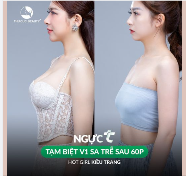Duy nhất 10 suất giảm 30% Ngực TC trong tháng 5 tạm biệt sa trễ