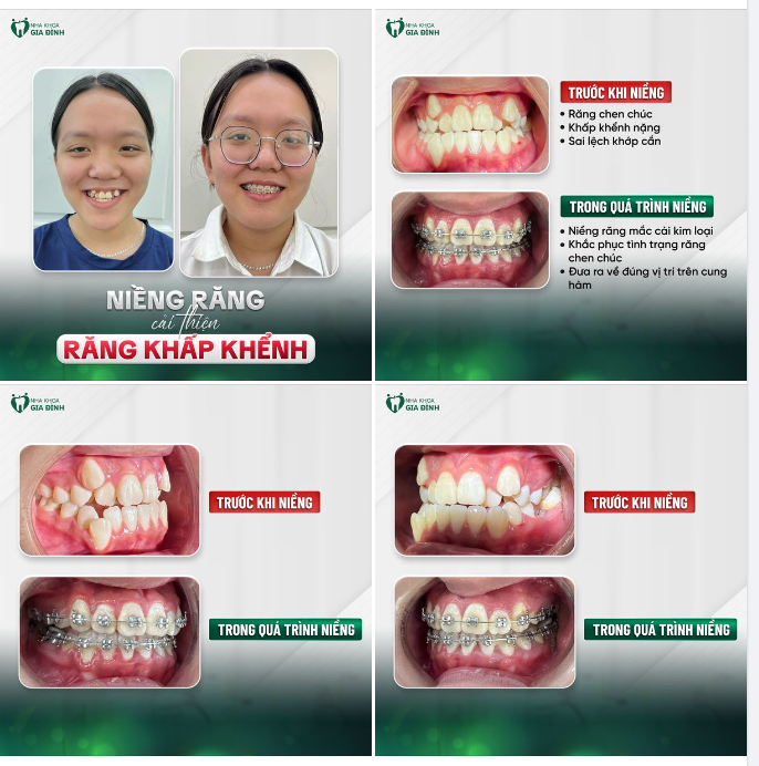 RĂNG KHẤP KHỂNH SẼ KHÔNG CÒN LÀ NỖI LO